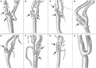 Effects of the Haemodynamic Stimulus on the Location of Carotid Plaques Based on a Patient-Specific Mechanobiological Plaque Atheroma Formation Model